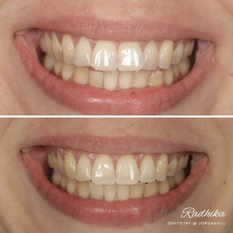 Before: crowded lower front teeth and a deep bite