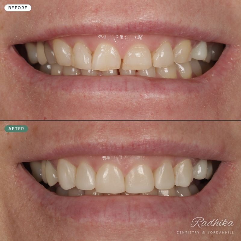 Before and after composite bonding closing gaps and levelling the edges of the upper front teeth
