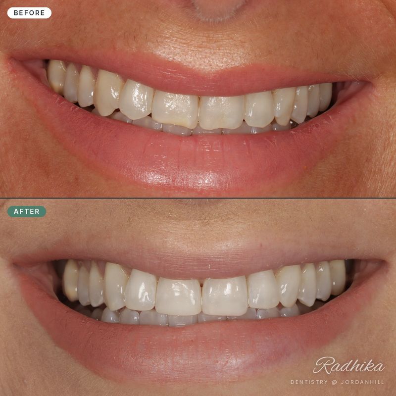Before composite bonding: chipped and worn upper tooth edges