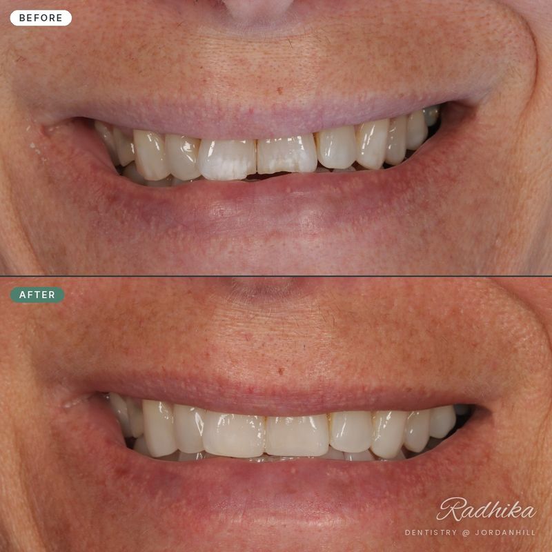 Before and after composite bonding evening out short, uneven and discoloured front teeth