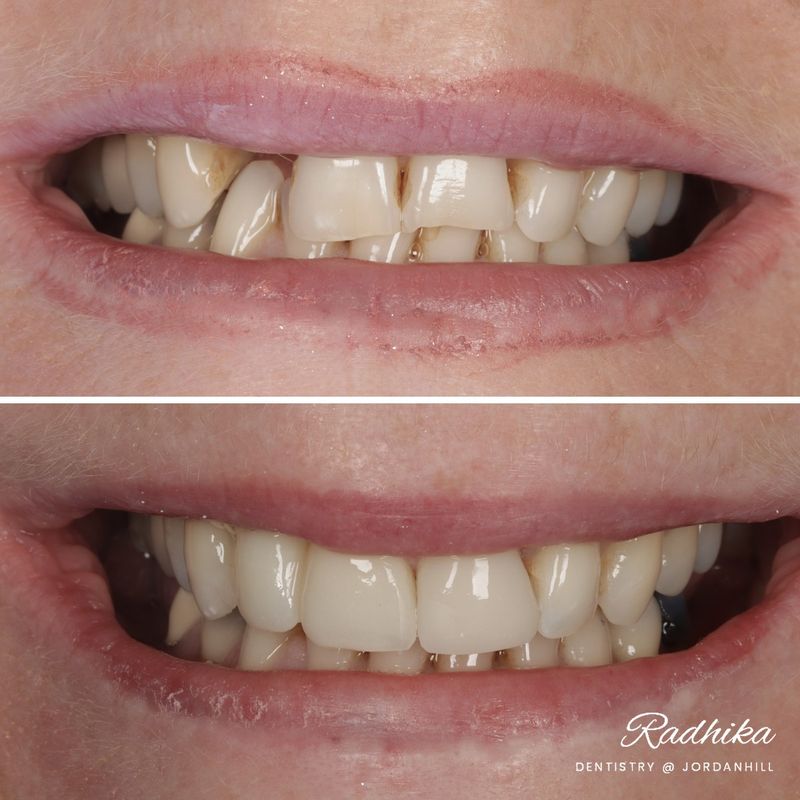 Before: a missing upper tooth alongside worn and uneven front teeth