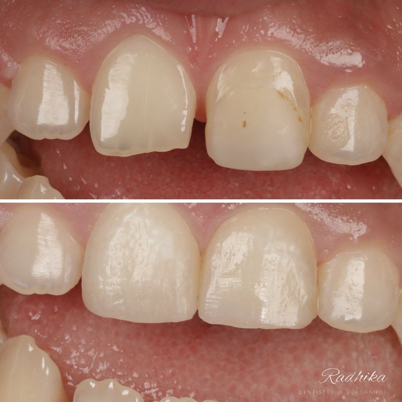 Before: a chipped upper front tooth with a broken corner