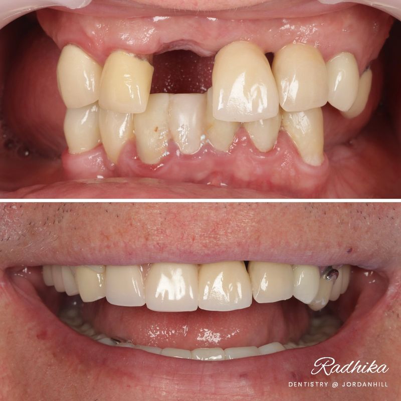 Before: missing teeth and broken-down lower teeth with failing bonding