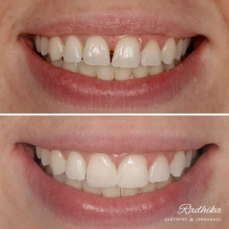 Before: a gap between the two upper front teeth