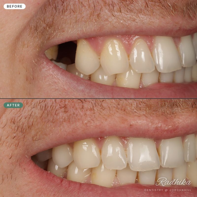 Before: a missing upper tooth leaving a gap in the smile