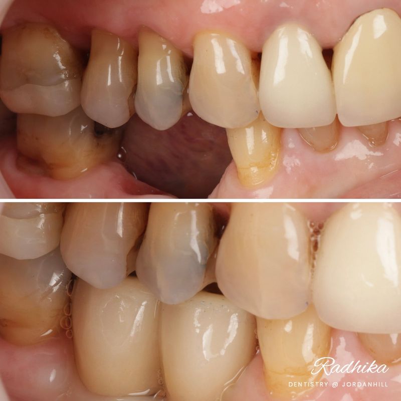 Before: a gap where lower back teeth are missing