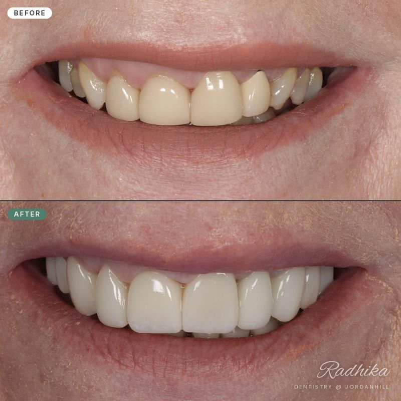 Before a smile makeover: teeth shortened by years of wear