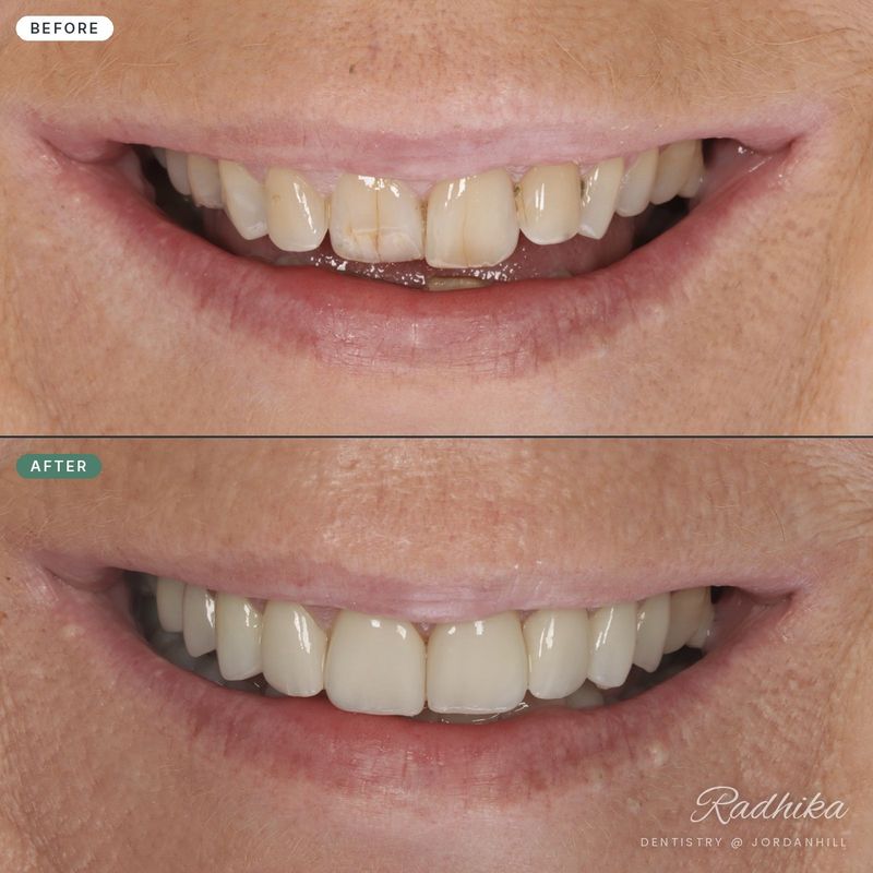 Before and after a smile makeover restoring worn upper front teeth with porcelain veneers
