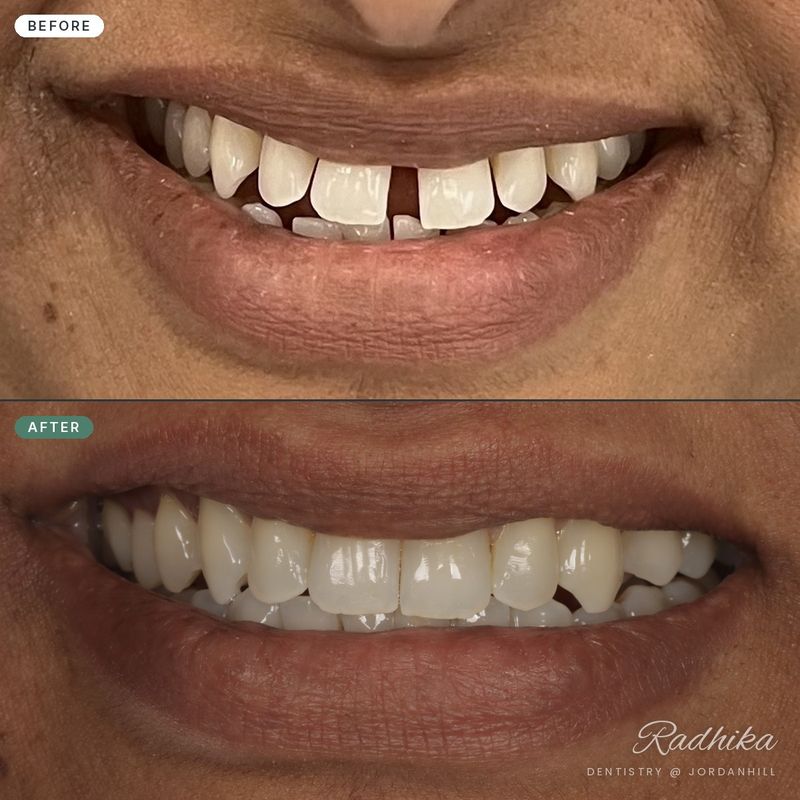 Before: spacing between several upper front teeth