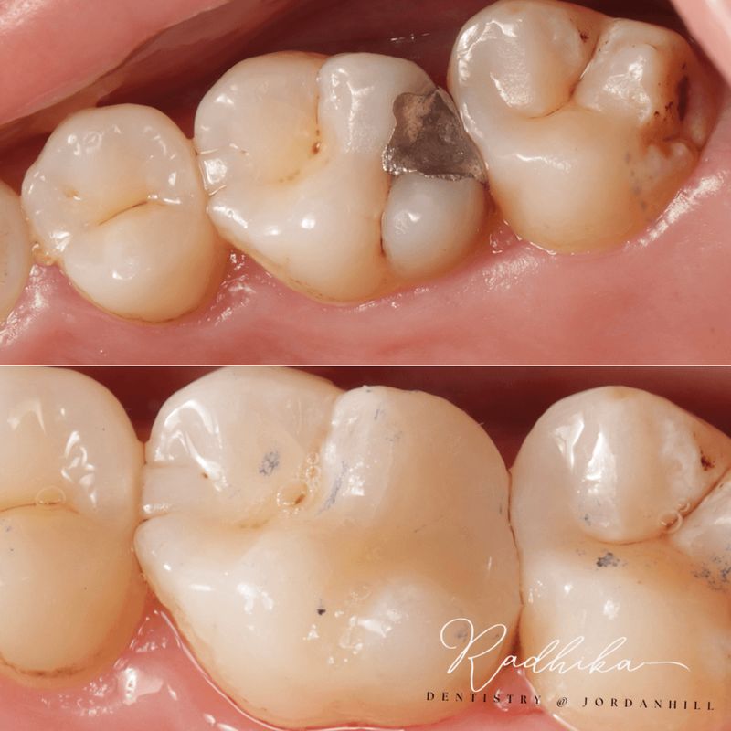 Before: a back tooth with an old silver amalgam filling