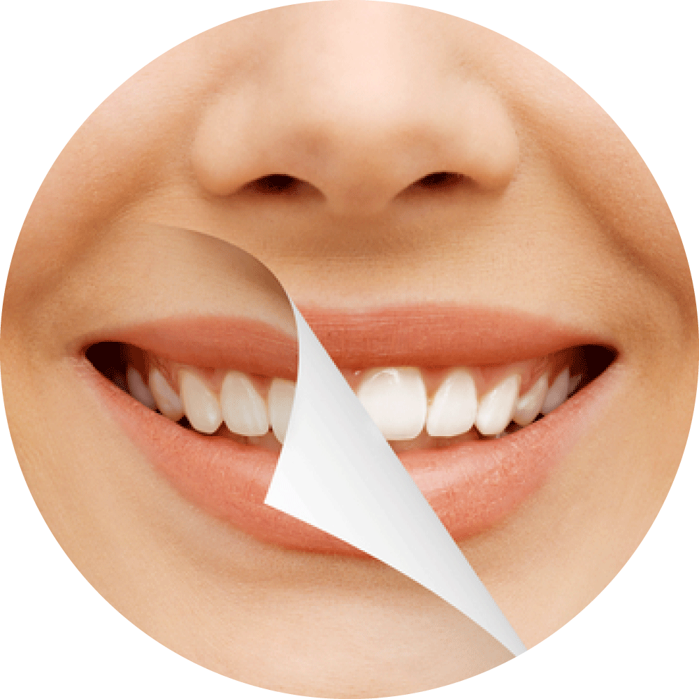 Professional teeth whitening in Jordanhill